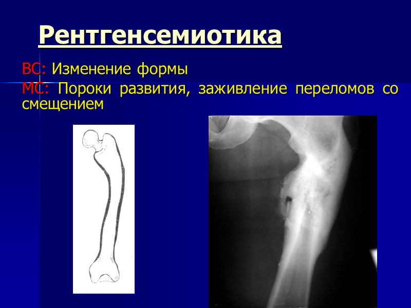 Рентгенсемиотика ВС: Изменение формы МС: Пороки развития, заживление переломов со смещением